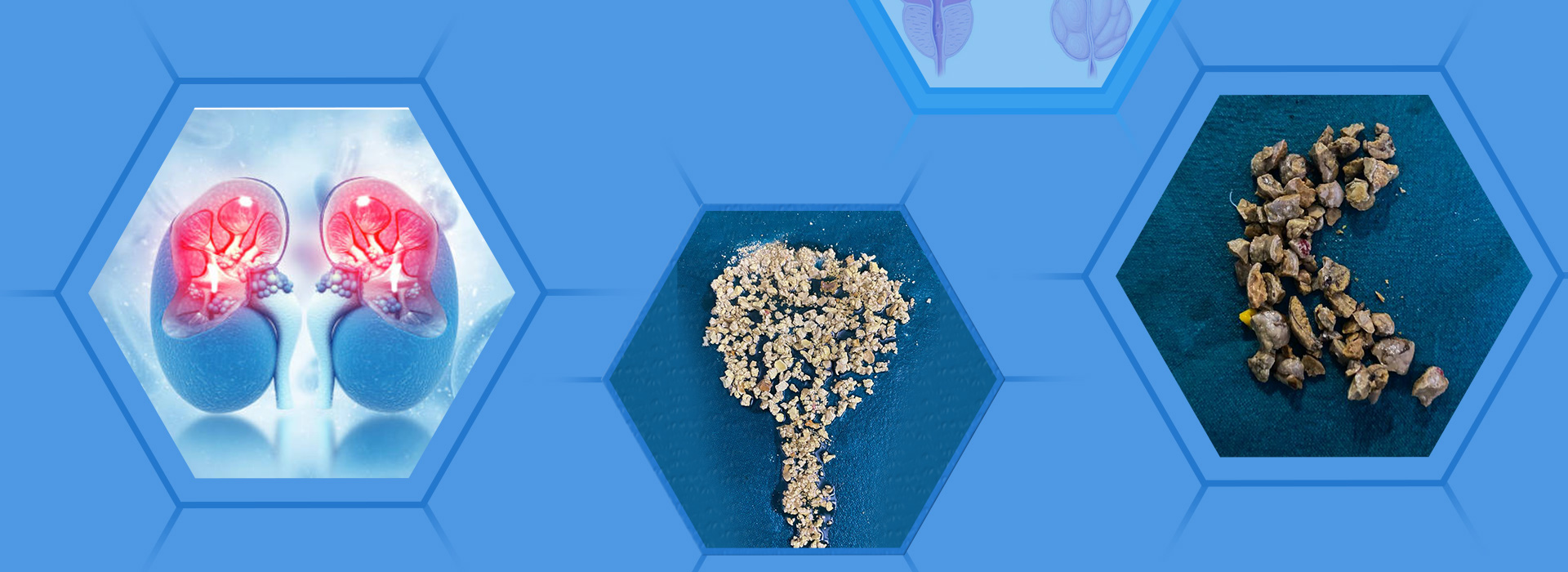 Kidney Stone Treatment in Hanamkonda